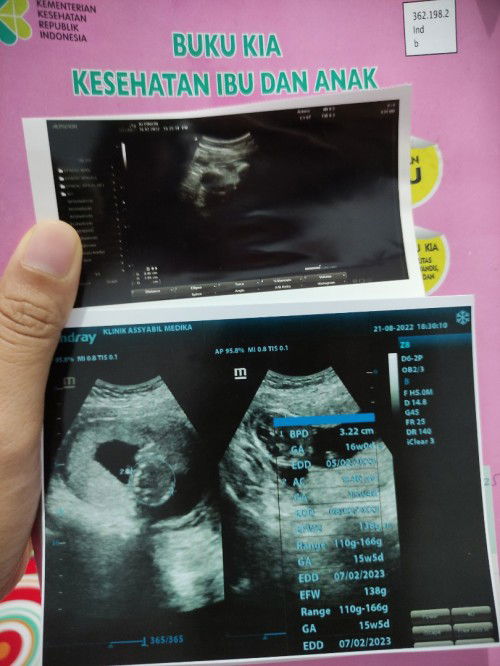 Hasil USG yg atas 9w blm klhtan apapun, Alhamdulillah USG kmrin sdah klhatan kntong & janinnya 15w