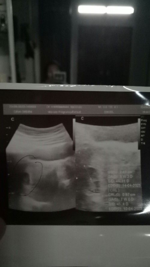 Perbedaan usia kehamilan