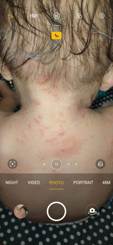 gatal gatal dan bintik merah