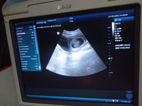 10 week 2 kantung janin