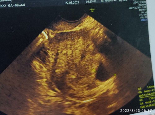 Blighted ovum (BO) 
Hamil kosong