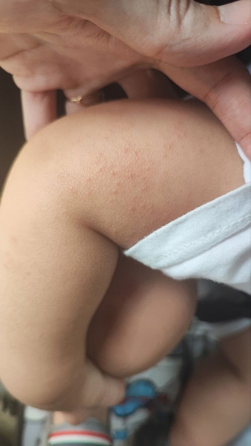 bentol bentol / bruntusan di sekitar siku tangan dan kaki