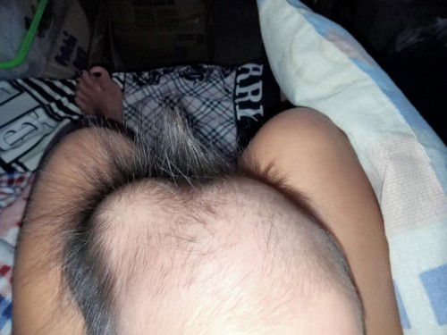Malambot na bukol sa ulo ni baby, ano po kaya dapat gawin?
