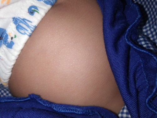 kulit kasar bintik²