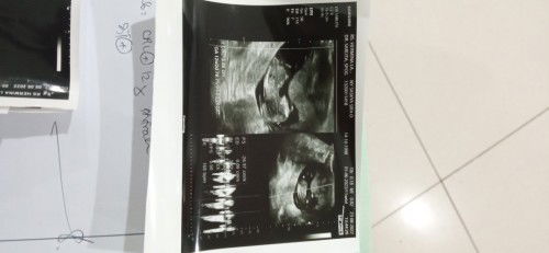 Hpht 1 juni, screening down syndr