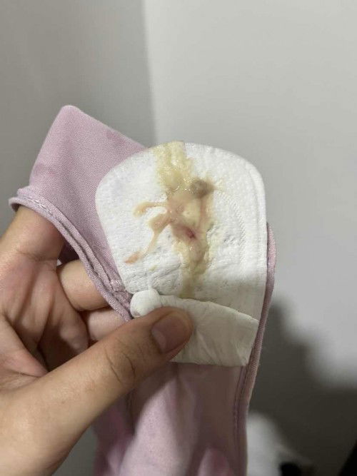 Keputihan bercampur darah sikit.