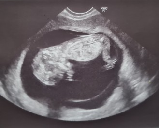 Ultrasound result 12 weeks