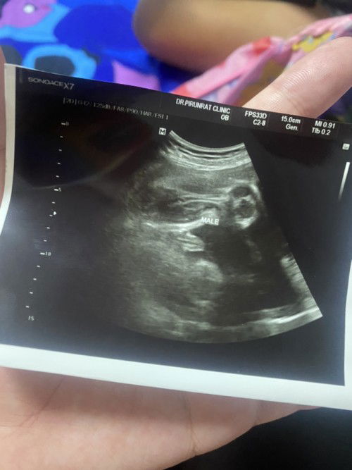 กลัวคลอดธรรมชาติไม่ได้กลัวลูกตัวใหญ่เกิน