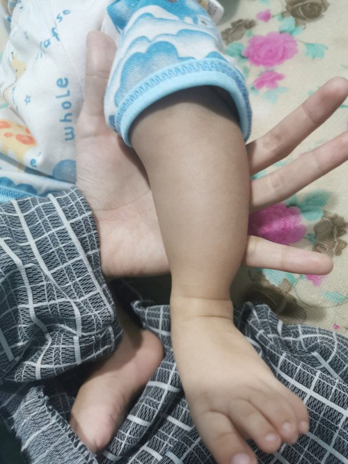 Saya mau tanya nih kak.
Kaki anak saya baru 3 bulan bengkok gini yaa kak? Aman ngga yaah..