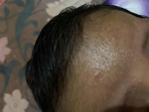 Bintik atau bruntusan atau biang keringet