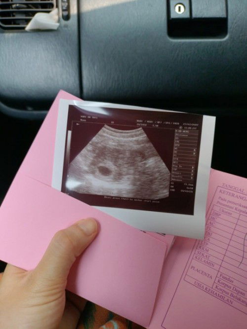 Di vonis blighted ovum dan harus di kuret usia kehamilan 3 bulan