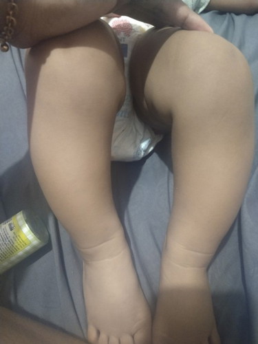 Bun mau tanya anak ku umur 9 bulan tapi kaki nya kayak bengkok apa ini bisa lurus apa tidak