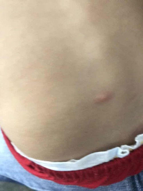 Badan anak naik bintat macam kena gigit nyamuk