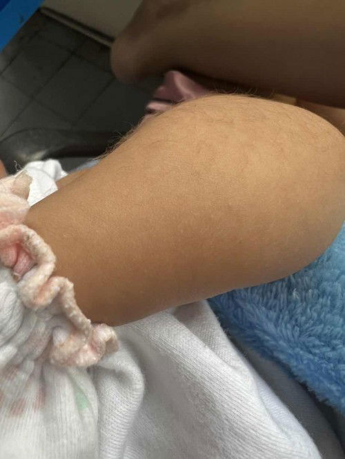 ใครเคยมีตุ่มแบบนี้ขึ้นกับลูกบ้างมั้ยคะ ?