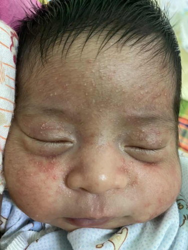 ผื่นขึ้นหน้าลูกไม่ทราบสาเหตุ