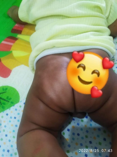 Kulit bayi ku kenapa ya