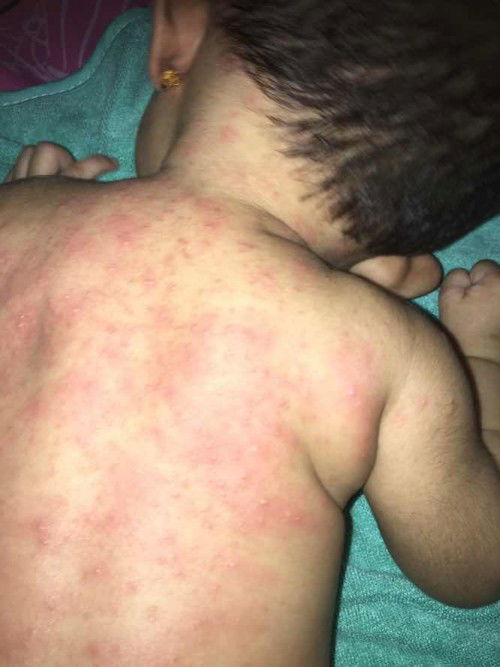 Bintik merah dengan cairan putih