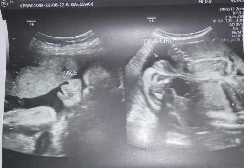 Normal lng po ba ganyan ung face ni baby sa ultrasound?prang kkaiba po kc ung face nya😟