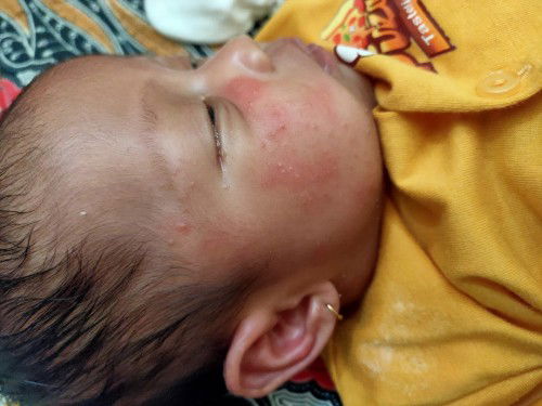 Wajah bruntusan merah