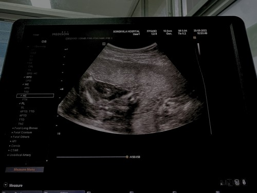 เเม่ๆบ้านไหนได้ลูกสาว มีภาพอัลราซาวตอนดูเพศมั้ยคะ จะเทียบว่าของเค้าใช่หญิงเเน่นอนมั้ยคะ เเต่คุณหมอบอกว่าหญิง❤️