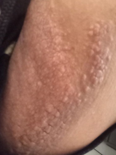 Rashes sa pagitan ng mga hita