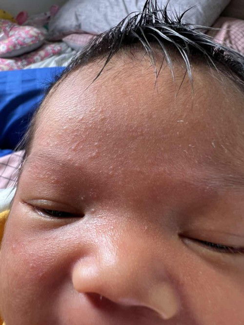 ทารกเป็นผื่นที่หน้า