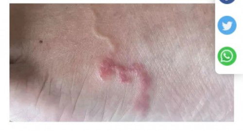 Cacing pada anak 1tahun 9bulan