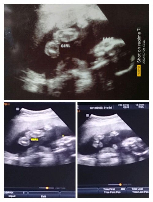 Gender Ultrasound result