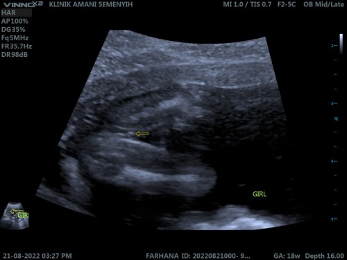 Gender 18 week