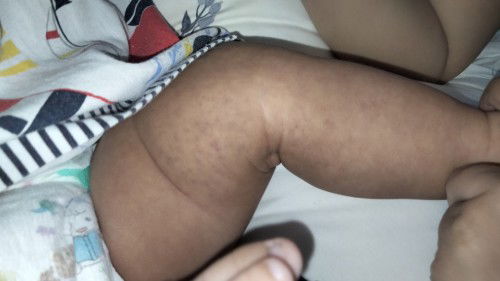 ขาลูกอายุ3เดือนเป็นรอยจ้ำจุดม่วงๆแบบนี้เกิดจากอะไรอันตรายไหมค่ะ