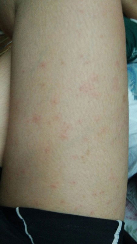Skin Allergy for 11 weeks