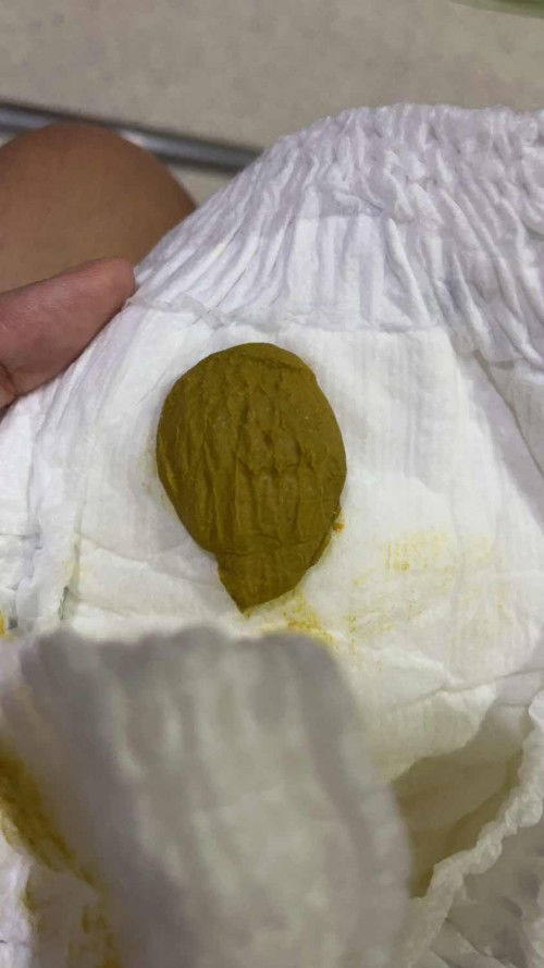 น้องถ่ายแบบนี้ต้องเปลี่ยนนมไหมค่ะ