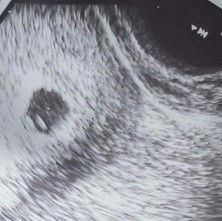 Transv ultrasound 5 weeks