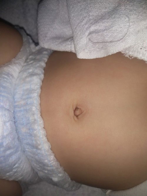 Langib or dumi sa Pusod ni baby 6 months old