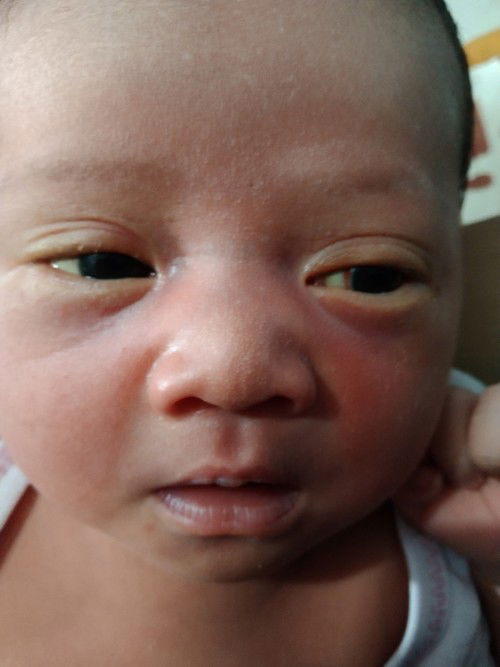 Bayi ku ada garis merah dkt bola mata