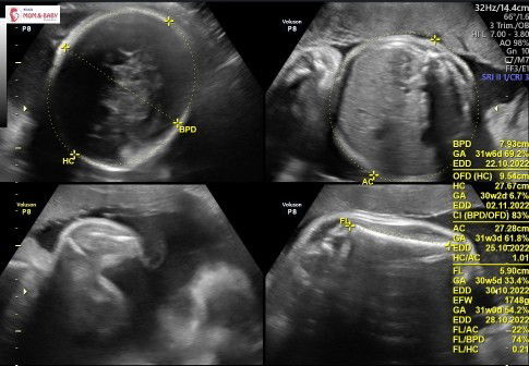Berat Janin 1.750 gr 31 minggu