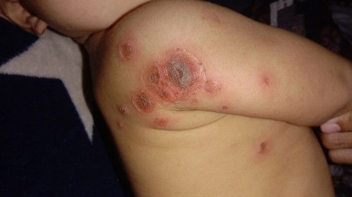 Kulit bayi luka merah melepuh dan menyebar