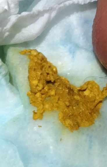 Normal lang po ba yung ganitong klase o kulay ng dumi newborn? Parang golden tas may buo buo.