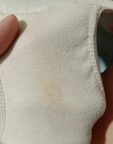 normal lng ba ung gnitong color ng discharge s underwear ? minsan sumasakit sakit ung puson ko.