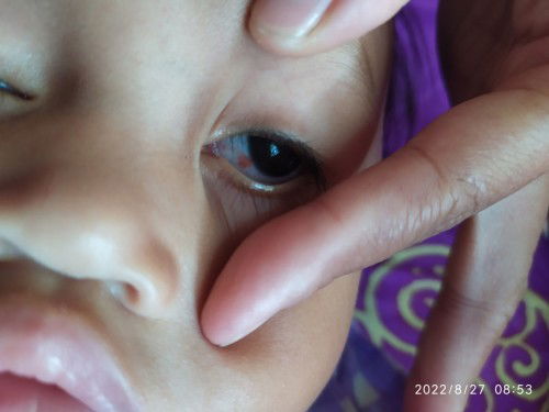 Mata ada gumpalan merah