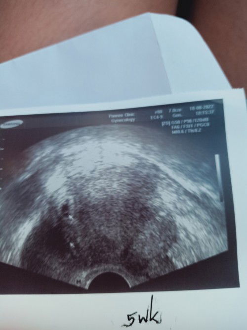 ถุงการตั้งครรภ์เอียงชิดมุม เสี่ยงท้องนอกมดลูก