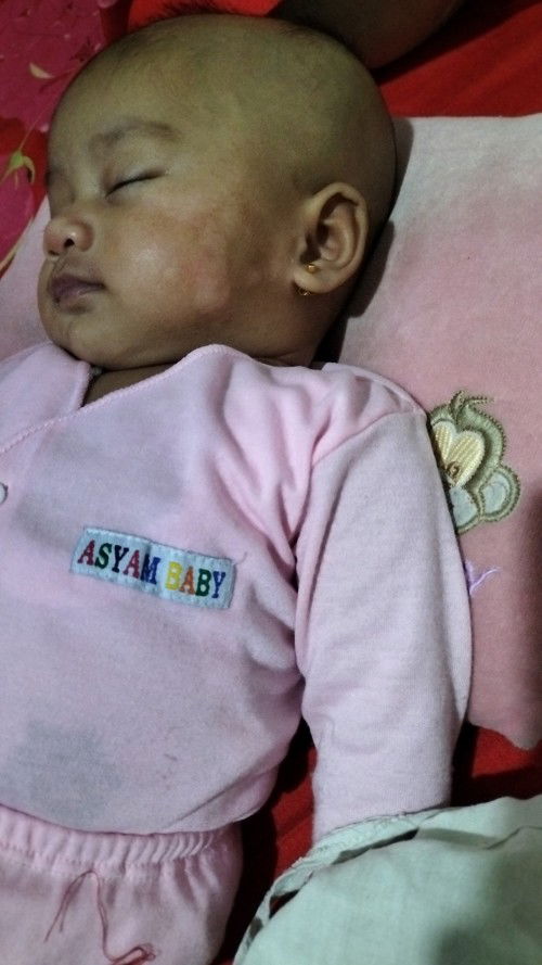 Cara mengatasi putih2 gmna ya Bun, mohon jawaban nya ya bunda2, bukan hnya d muka tp juga d badan