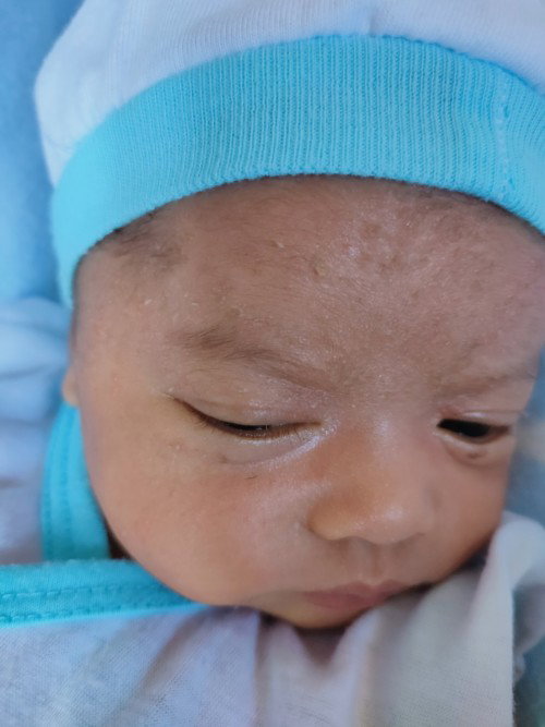 baby dandruff/seborrheic dermatitis