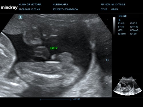 Scan gender 21 weeks