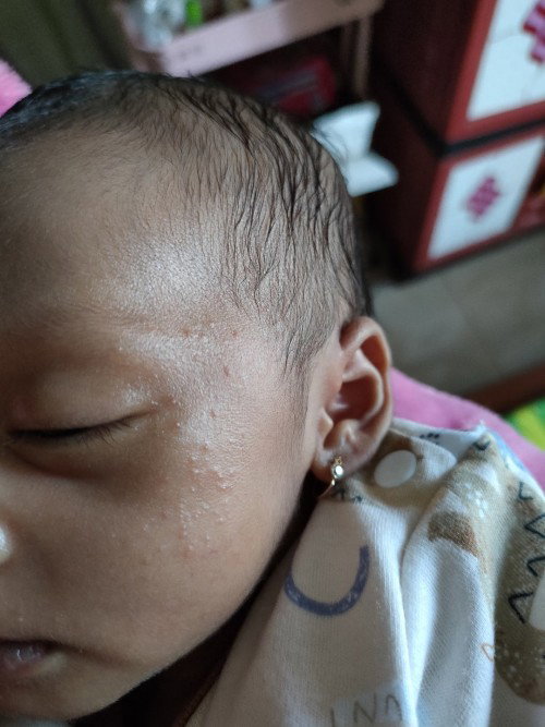 Beruntusan merah dipipi bayi
