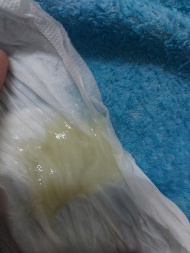 ขอสอบถามหน่อยค่ะ พอดีตอนนี้อายุครรภ์ 39 w 5d มีมูกลักษณะแบบนี้ออกมาจากช่องคลอดค่ะ