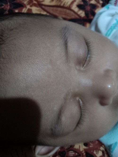 Bercak putih di wajah bayi