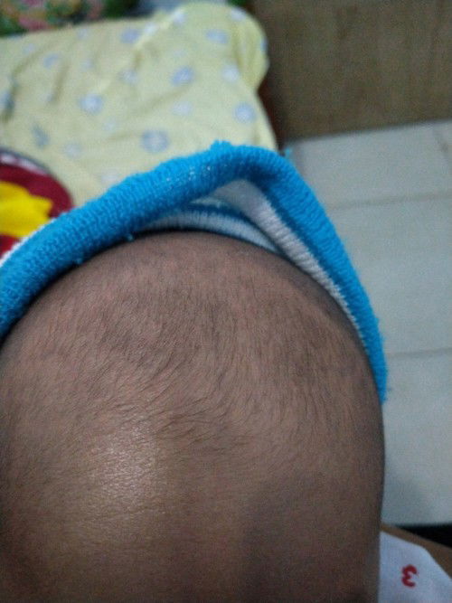 apakah urine bayi 2bln seperti ini tanda dehidrasi soalnyaa ubun ubunnya cekung bgt kalau nangis