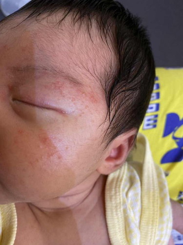 Baby Acne or Bungang Araw??