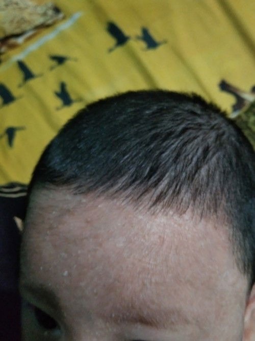 Kepala bayi berkerak